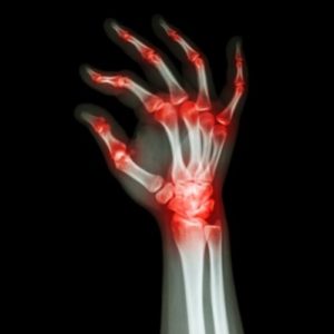 A weak grip can complicate working with a chainsaw